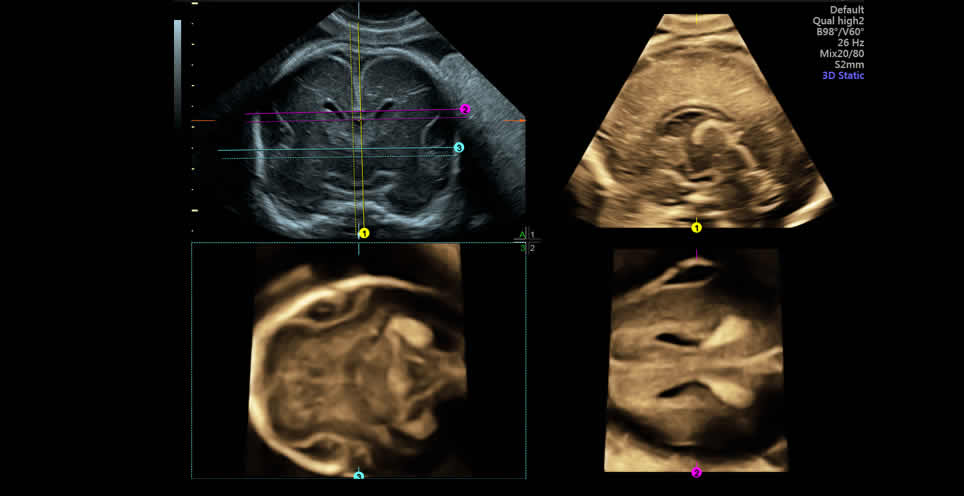 Υπερηχογράφημα εμβρυϊκής ανατομίας