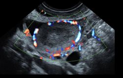 GEHC-gynecological-ultrasound_HDFlow