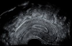 GEHC-gynecological-ultrasound_contrast_resolution